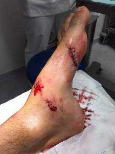 Jean-Mat de Ridder's foot injury