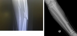 Alessio Stillrich's broken bones before and after the surgery in Cape Town in January 2018