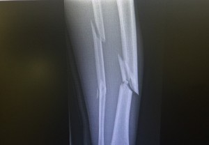 Alessio's fracture from January in South Africa 2018